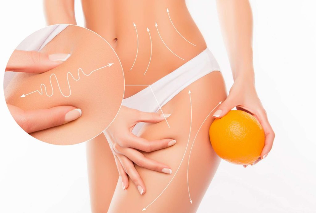 Νέα δεδομένα κατά της κυτταρίτιδας